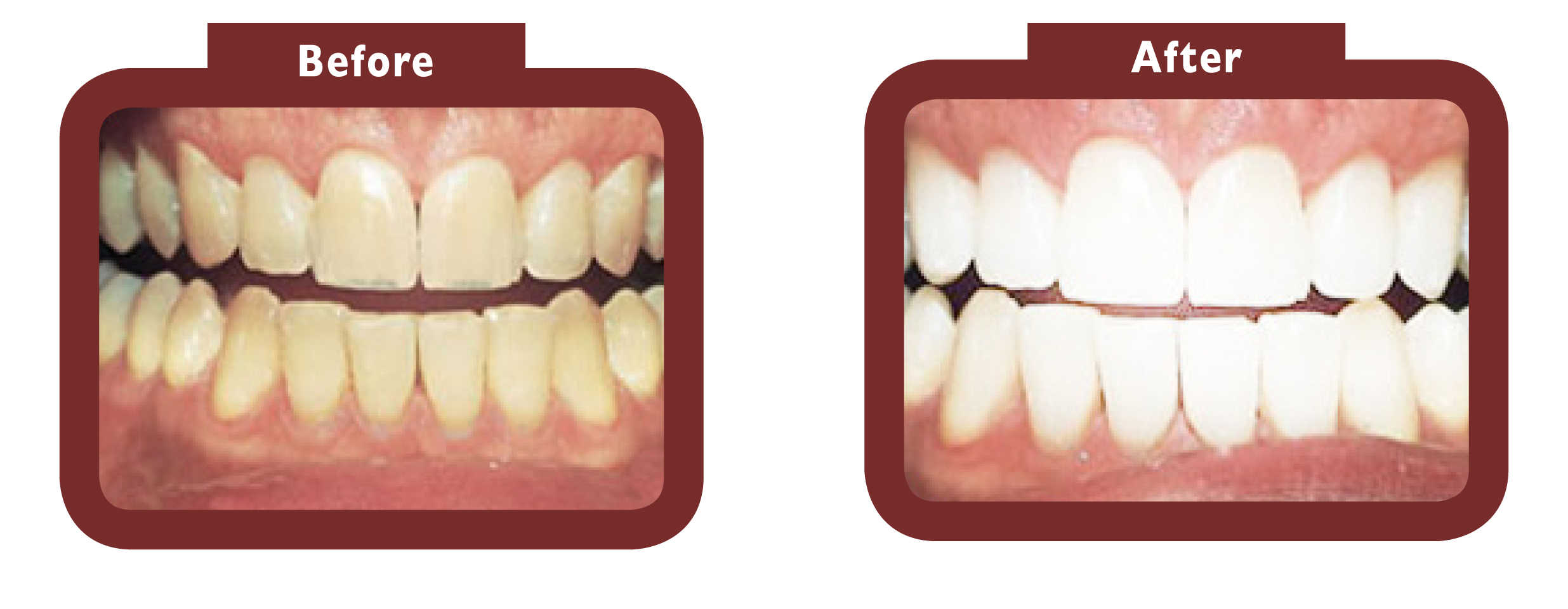 before and after teeth whitening - LA TEETH Portsmouth