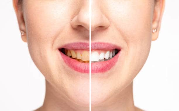 Teeth Whitening Milton Keynes Portsmouth