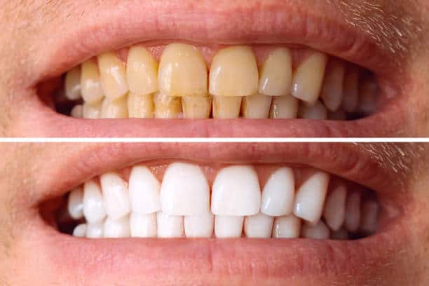 Laser White For Ever Bright – Get a Brighter, Whiter Smile with LA Teeth Whitening Portsmouth