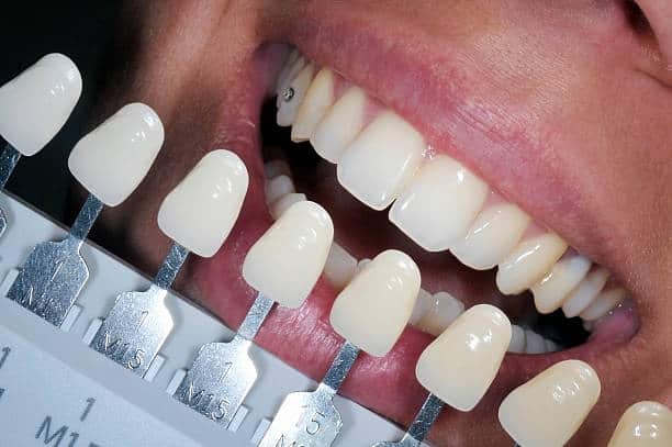 Get Natural and Stunning Smile with Teeth Whitening Results from LA Teeth Whitening Portsmouth