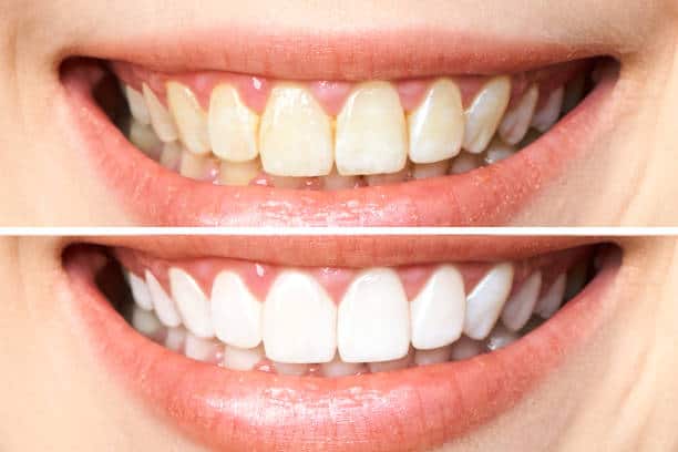 Achieve a Dazzling Smile for Your Special Day: A Guide to Wedding Teeth Whitening Portsmouth