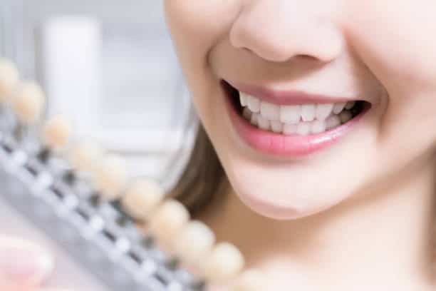 Teeth Whitening Kings Norton Portsmouth