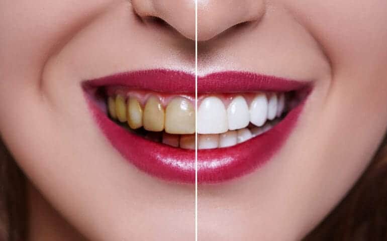 Teeth Whitening Ascot Windsor Portsmouth