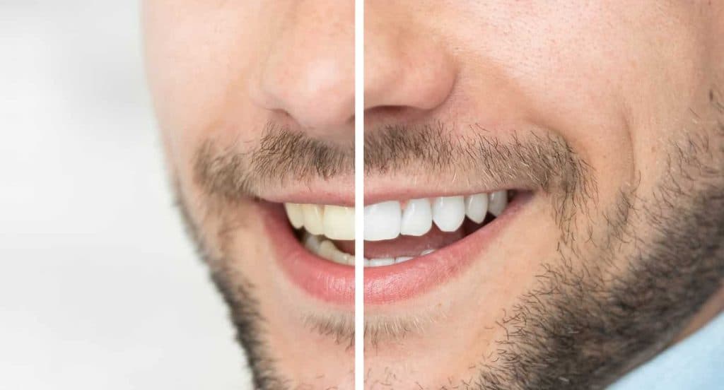 Teeth Whitening Bedfordshire Portsmouth