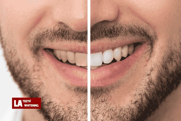 Book in for laser whitening today! Portsmouth
