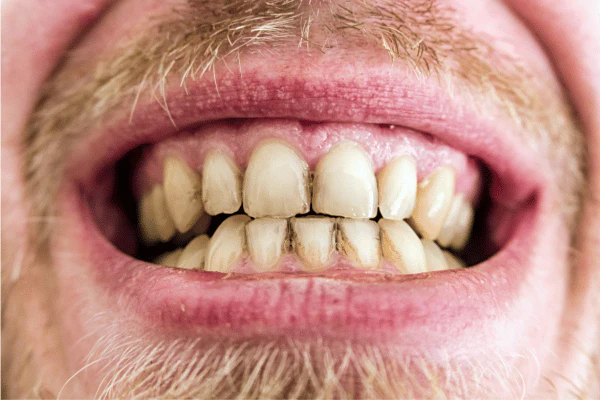 Does Lazer Teeth Whitening Work for Smokers Portsmouth